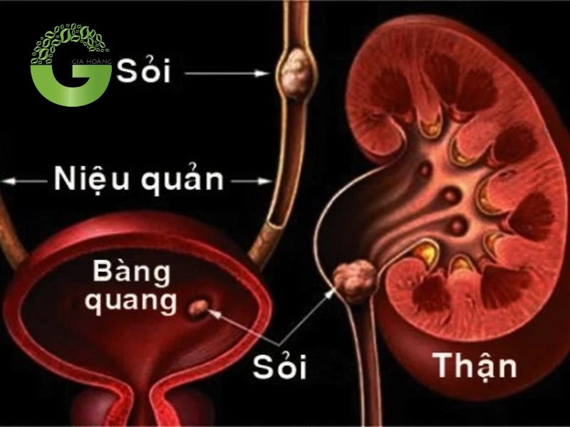 Uống nước cứng lâu ngày tăng nguy cơ sỏi thận, sỏi tiết niệu