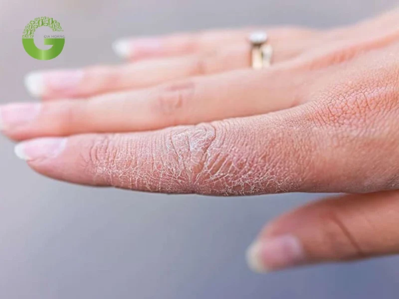 Vôi tôi có thể gây tình trạng khô da nếu tiếp xúc lâu