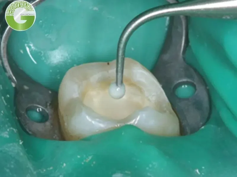 Canxi Hydroxit trong Nha khoa